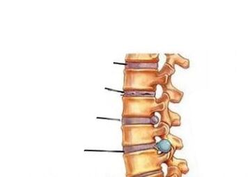 Čtyři fáze vývoje osteochondrosy